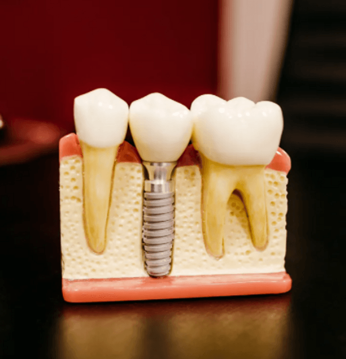 Complete Dental Implant | Original Cost $4500