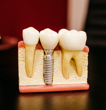 Complete Dental Implant | Original Cost $4500