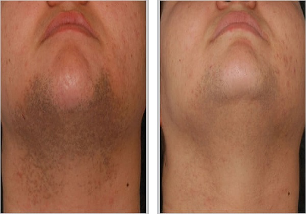 Chin
