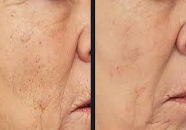 Non-Ablative Skin Resurfacing ( 1550/1940 Treatment)