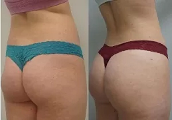 Buttocks