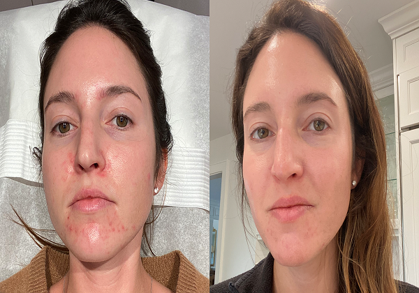 VI Chemical Peel