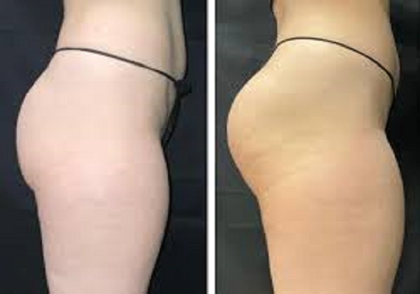 Emsculpt NEO Buttock