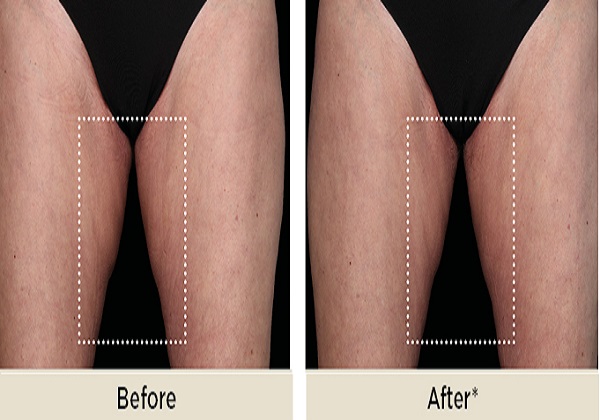 Emsculpt NEO - Upper Front Leg