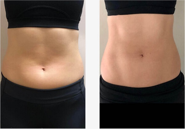 Emsculpt NEO Flanks