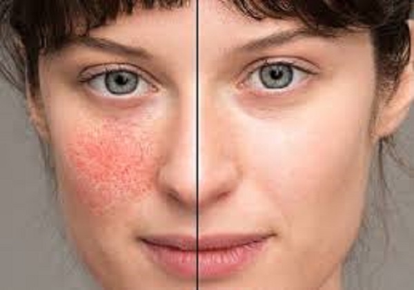 Rosacea Treatment