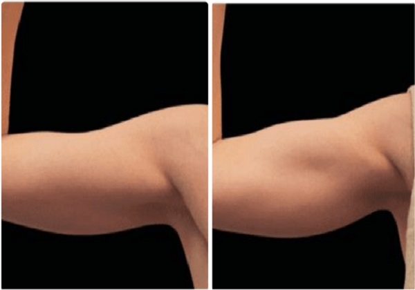 Emsculpt NEO Upper Inner Arm