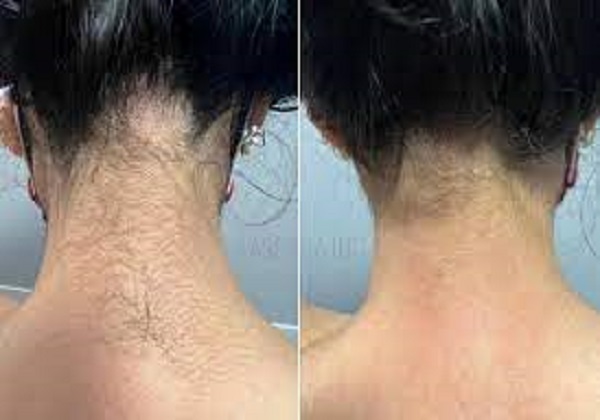 Neck (Back)