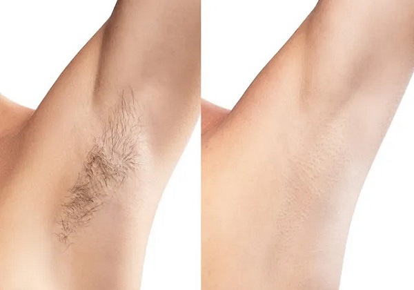 Underarms