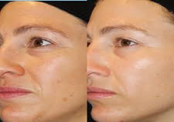 Laser Anti-Aging
