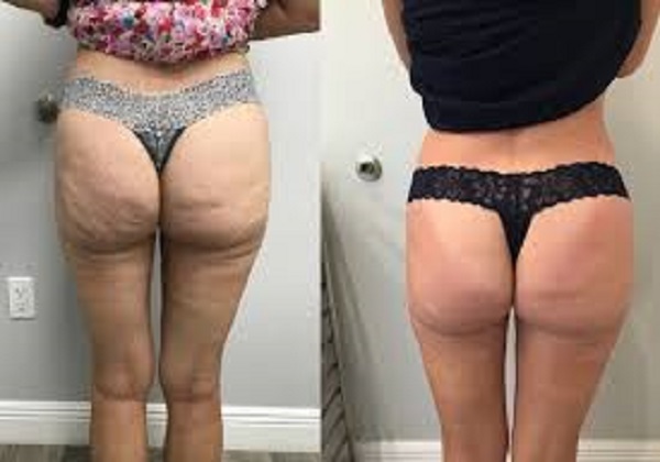 Emsculpt NEO - Upper Back Thigh